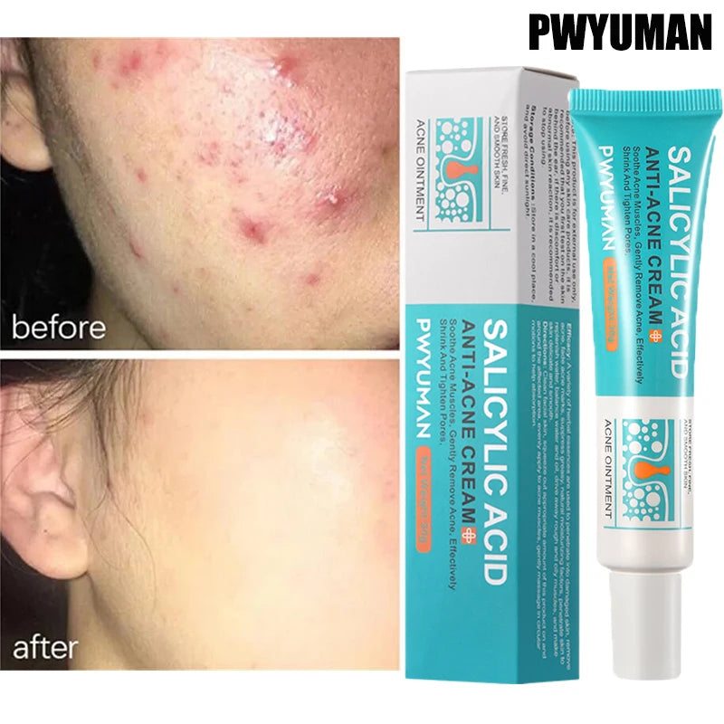 Salicylic Acid Acne Cream – Pimple Removal & Oil Control Moisturizer