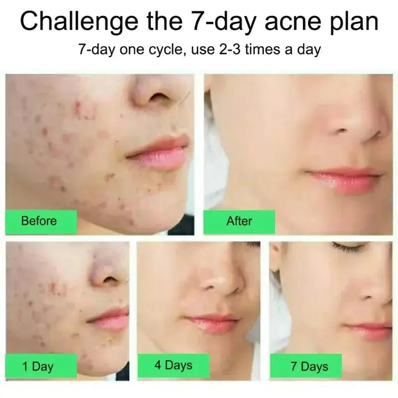 Salicylic Acid Acne Cream – Pimple Removal & Oil Control Moisturizer