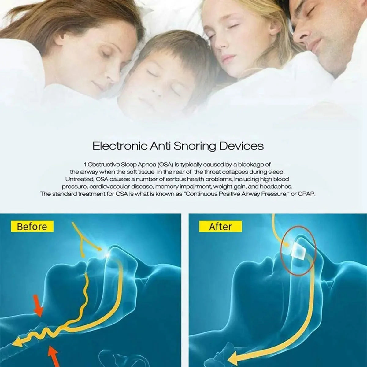 Electronic Anti-Snoring Device – USB Rechargeable Nose Vent